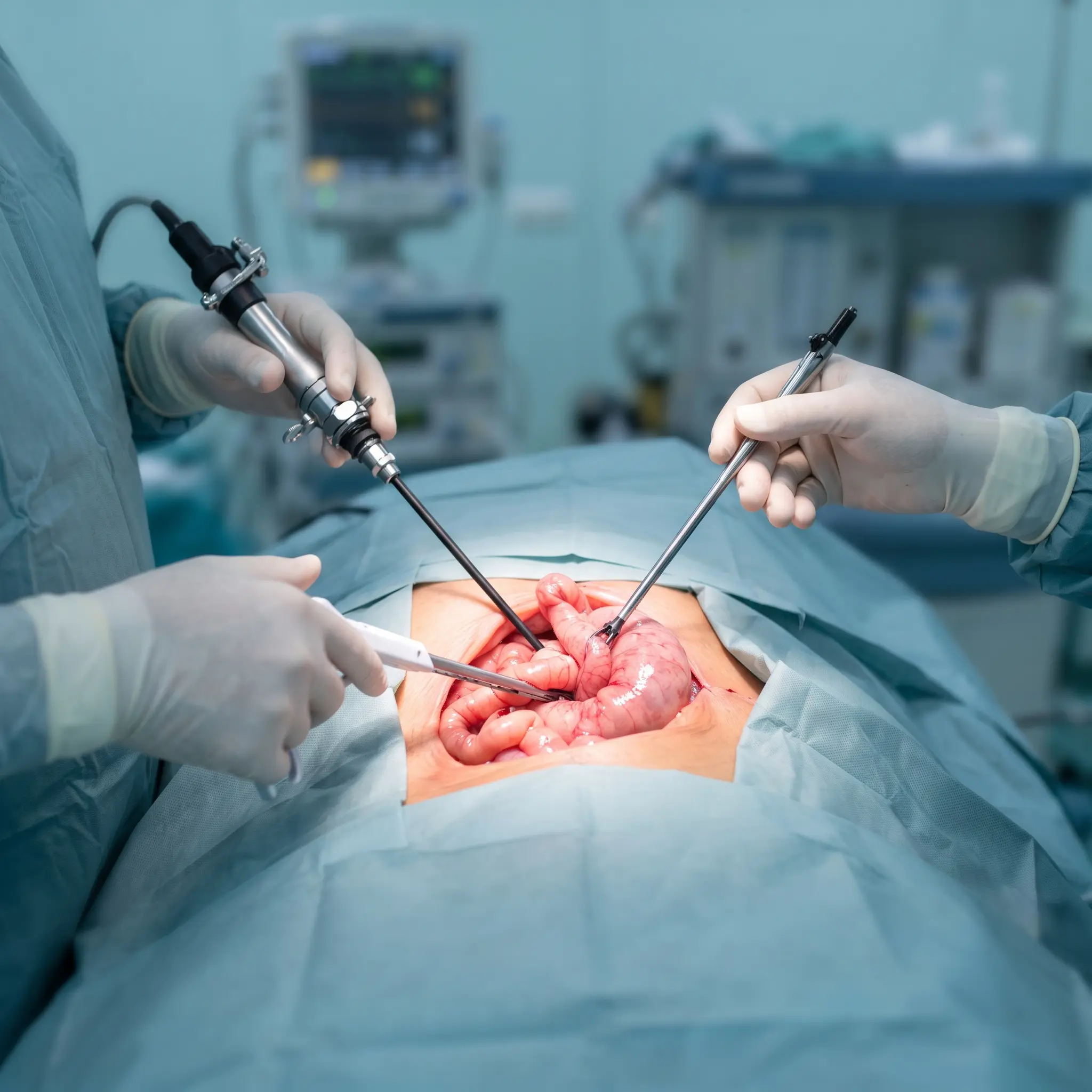 Gastric Bypass Surgery at Cleveland Clinic